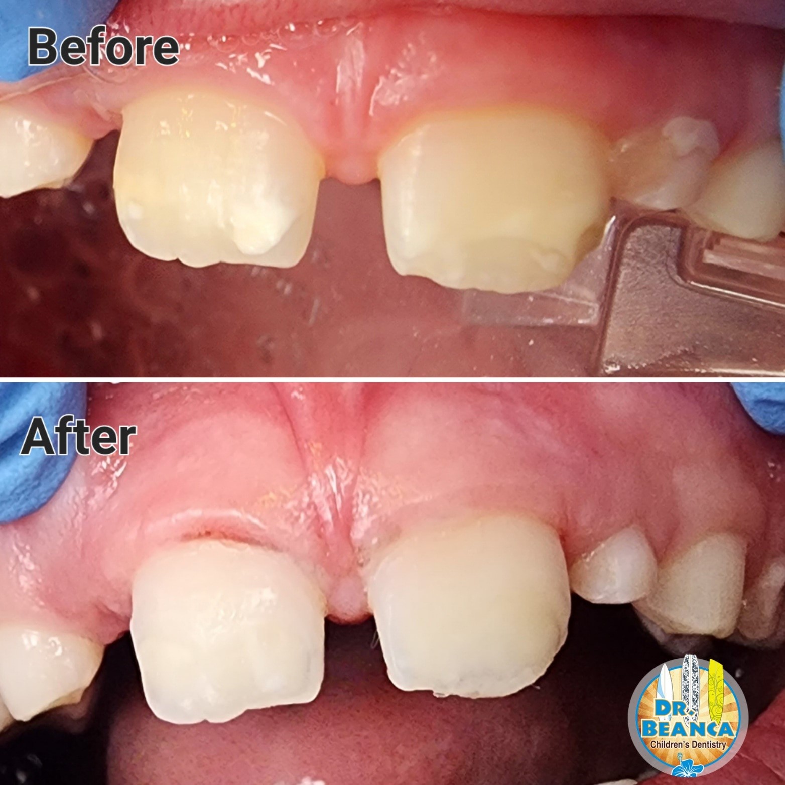Before & After Congenital Enamel Defects